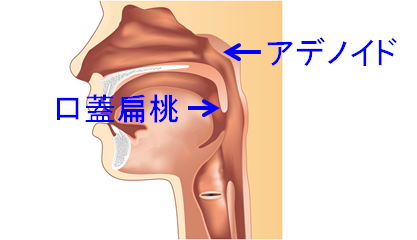 扁桃 炎 繰り返す